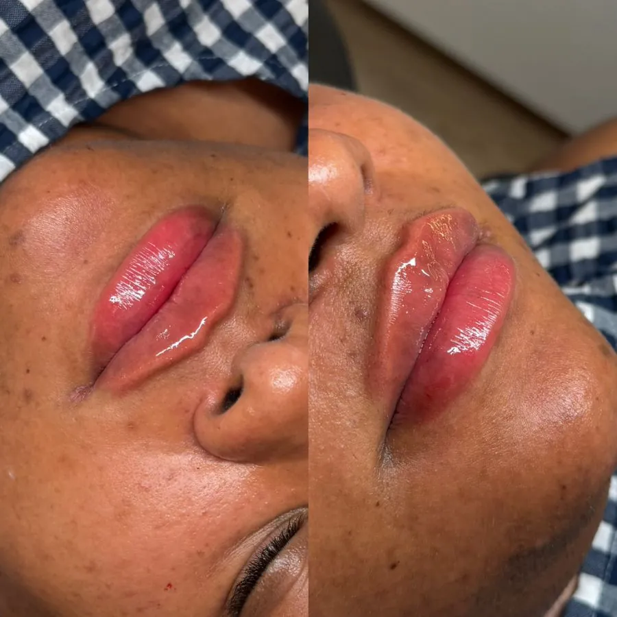Lip filler result